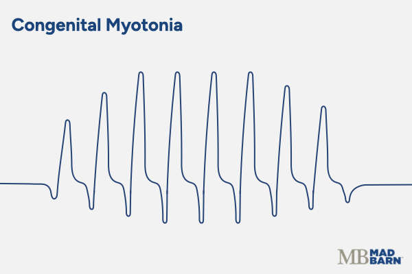electromyographic findings congenital myotonia