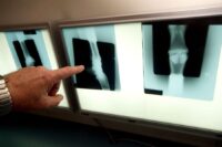 Limb Fractures in Horses: Risk Factors, Treatments & Prognosis